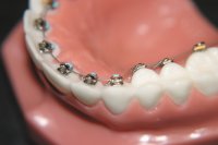 Ортодонтия и ее особенности
